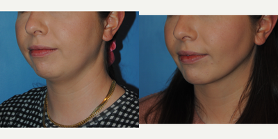 Chin Liposuction before and after photo