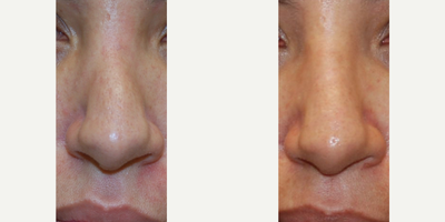 Dermal Fillers before and after photo
