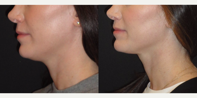 Kybella before and after photo