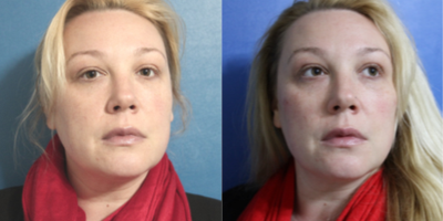 Liquid Facelift before and after photo