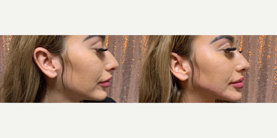 Liquid Facelift before and after photo