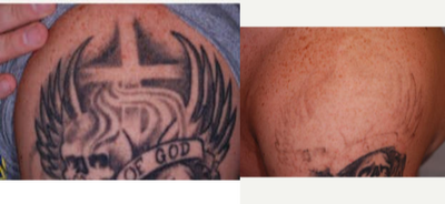 PicoWay before and after photo