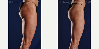 Smart Lipo before and after photo