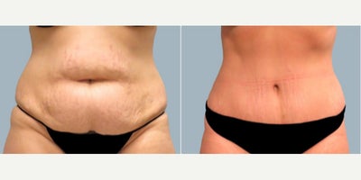 Tummy Tuck before and after photo