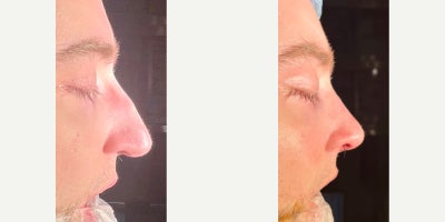 Revision Rhinoplasty before and after photo