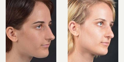 Rhinoplasty before and after photo