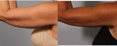 BodyTite before and after photo
