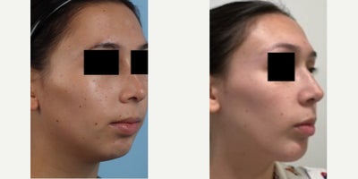 Chin Implant before and after photo