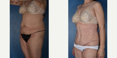 Drainless Tummy Tuck before and after photo