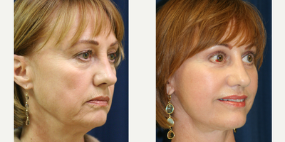 Facelift before and after photo