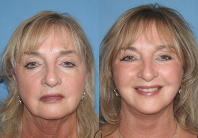 Facial before and after photo