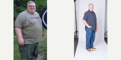 Gastric Sleeve Surgery before and after photo