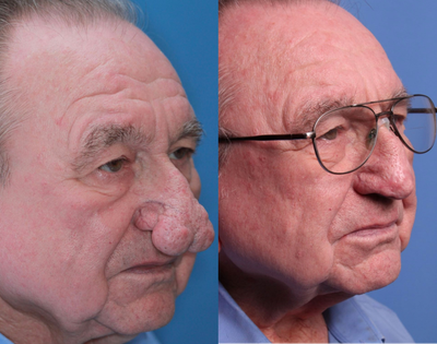Skin Rejuvenation before and after photo