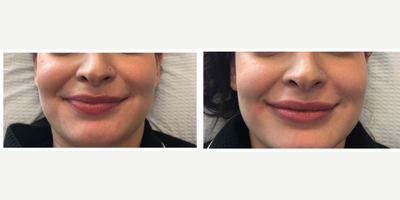 Volbella before and after photo