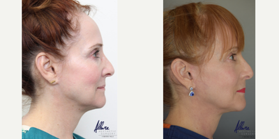 Facelift before and after photo