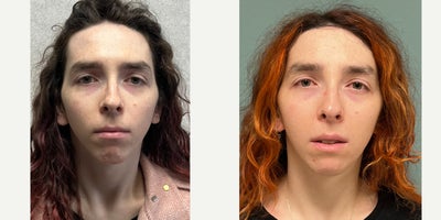Forehead Reduction before and after photo