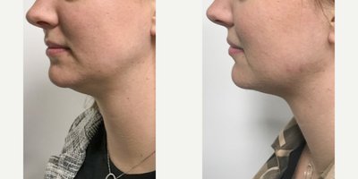Kybella before and after photo