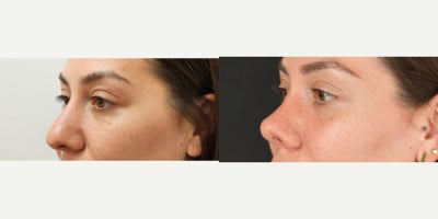 Rhinoplasty before and after photo