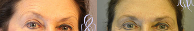 Botox before and after photo