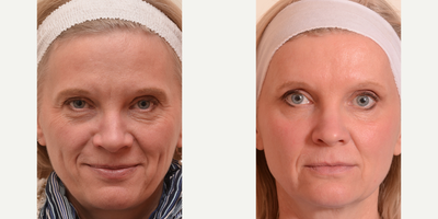 Skin Tightening before and after photo