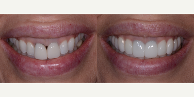 Dental Crown before and after photo