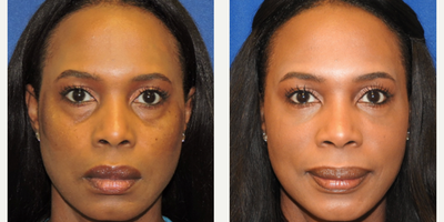 Eyelid Surgery before and after photo