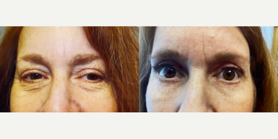 Eyelid Surgery before and after photo
