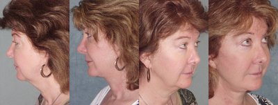 Facelift before and after photo