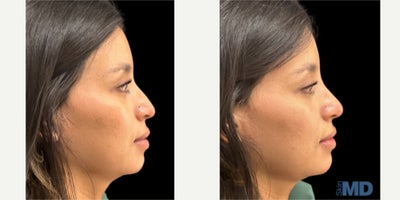 Nonsurgical Nose Job before and after photo