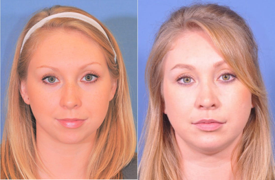 Rhinoplasty before and after photo