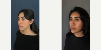 Rhinoplasty before and after photo