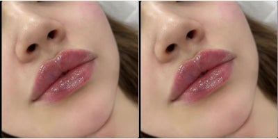 Dermal Fillers before and after photo