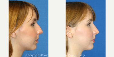Rhinoplasty before and after photo