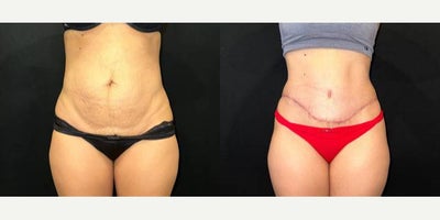 Tummy Tuck before and after photo