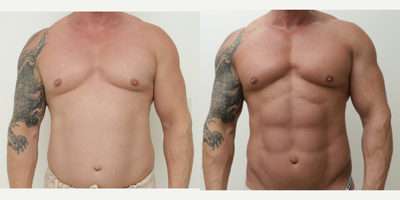 Abdominal Etching before and after photo