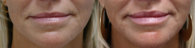 Dermal Fillers before and after photo