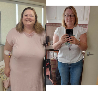 Gastric Sleeve Surgery before and after photo
