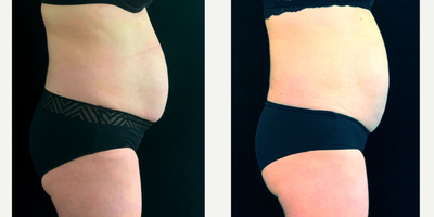 SculpSure before and after photo