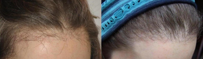 Hair Transplant before and after photo