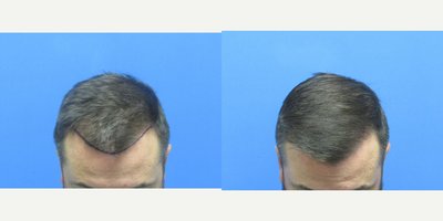 Hair Transplant before and after photo