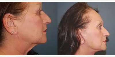 Neck Lift before and after photo