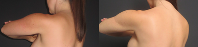 Liposuction before and after photo