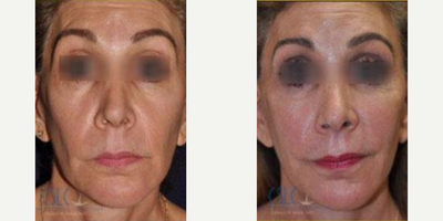 Sculptra before and after photo