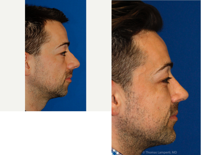 Chin Implant before and after photo