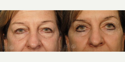 Double Eyelid Surgery before and after photo