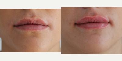 Lip Fillers before and after photo
