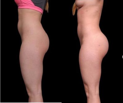 Brazilian Butt Lift before and after photo