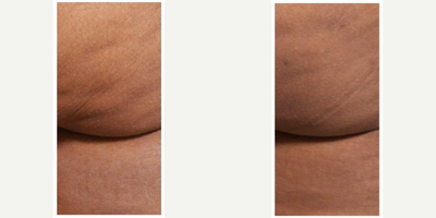 Cellfina before and after photo