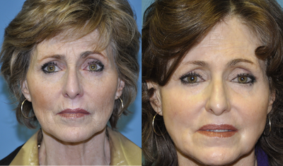 Chemical Peel before and after photo