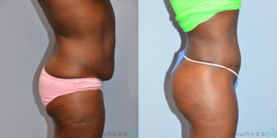 Liposuction before and after photo